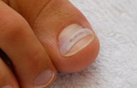 Podologie Blatti nagelspange